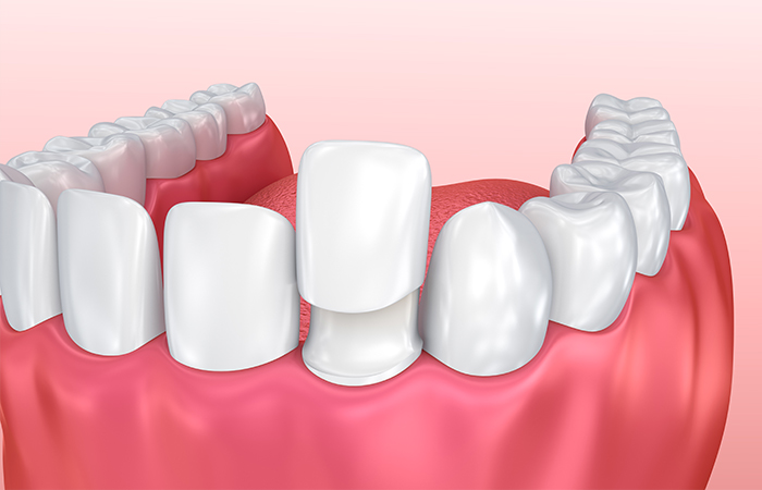 ラミネートベニア