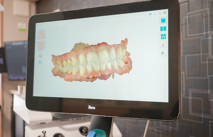 口腔内3Dスキャナー（iTero）