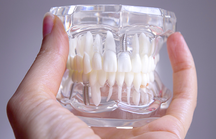 インプラントとは？