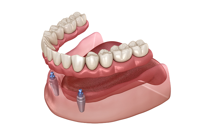 入れ歯が動いてしまう、違和感がある
