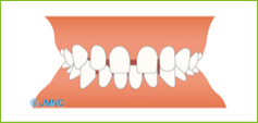 空隙歯列