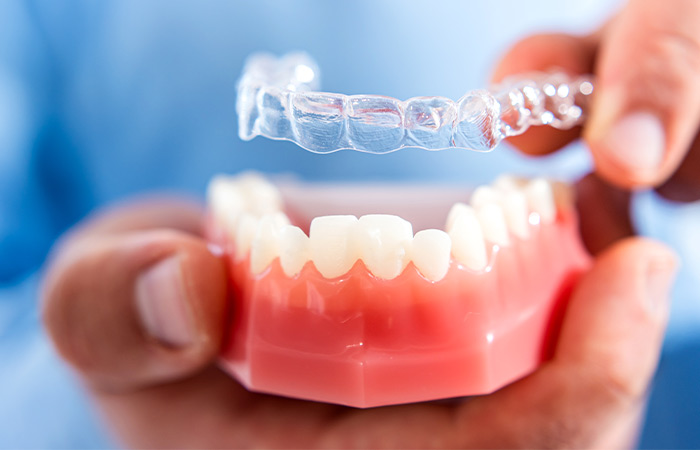 治療計画とマウスピースの製作