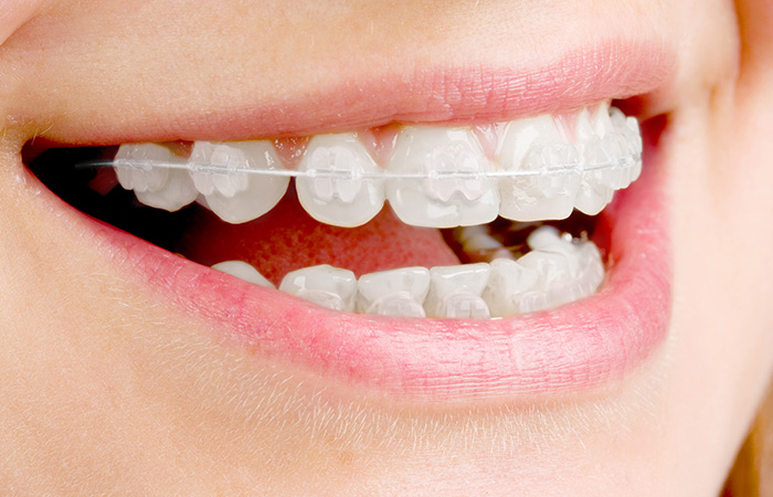 審美ブラケット