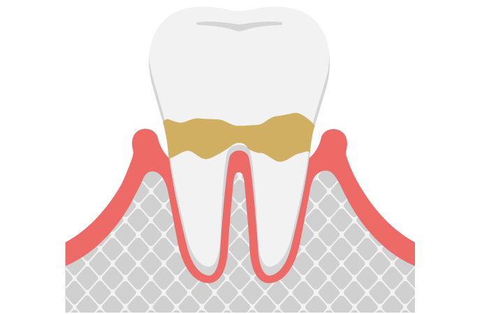 歯肉炎（軽度）