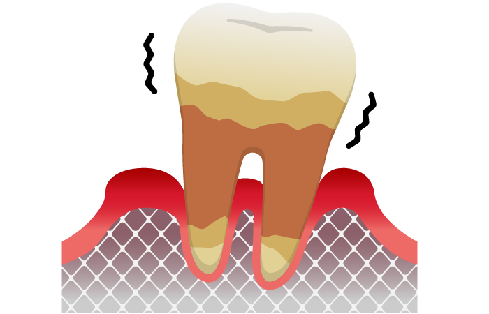 歯周炎（重度）